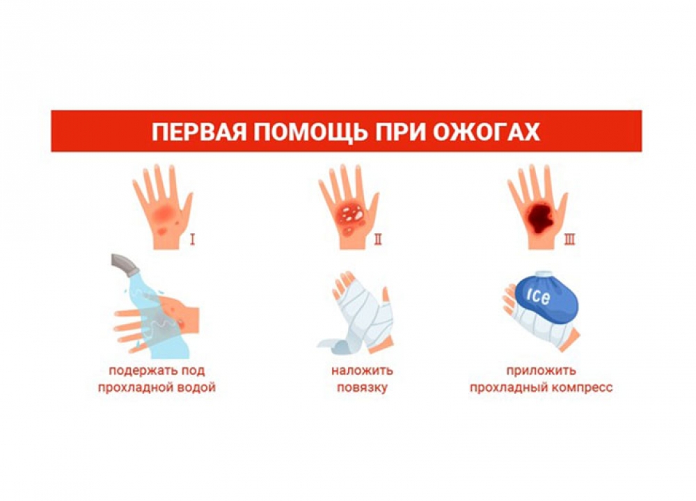 Как помочь человеку с термическими ожогами?